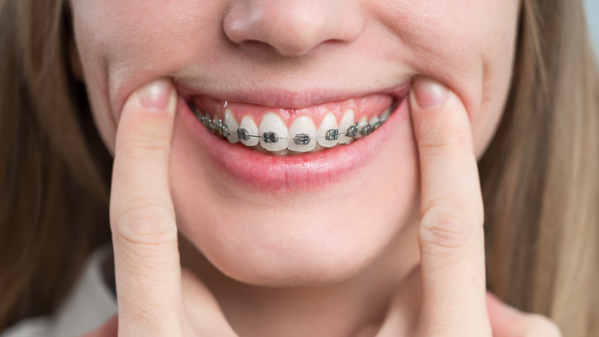 Perio-ortho synergy: “Excellent periodontal health is mandatory for a predictable orthodontic outcome”