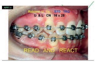 10 months:  Rebonded 11-21 with standard torque. 16x25 CN maxill. and mand.