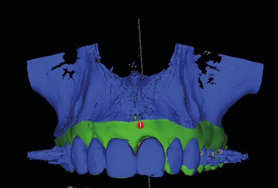 Fig. 10a: Un guide avec forage pilote est fabriqué d’après les reconstructions CBCT en 3D.