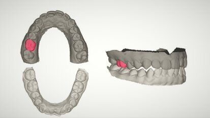 Artificial intelligence may automate design of biomimetic single-tooth protheses