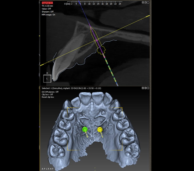 Fig. 3: Orthodontic implant placement design, followed by determination of the appliance’s function, adapted to the patient’s oral anatomy. 