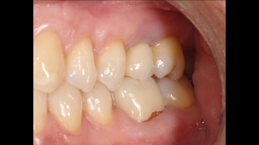 Fig. 7 - Visione clinica del sito 2.5 post-trattamento (3 mesi).