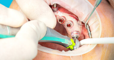 Redefining implant therapy with digital planning, guided placement and use of CONNECT abutments