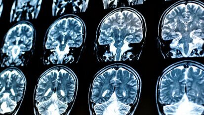 Nieuwe studie suggereert verband tussen hersenfunctie en mondgezondheid