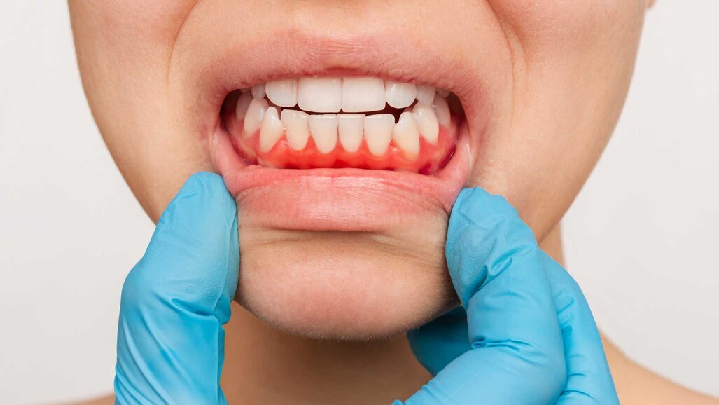 Früherkennung von Gingivitis durch neuen Test