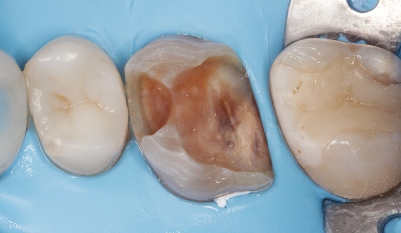 Fig. 7: PTFE tape placement for improving isolation in the gingival area. (Image: Kuraray Noritake Dental)