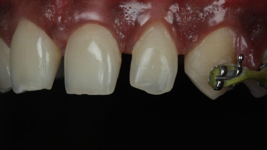 Fig 9: Maxillary incisors brackets debonded