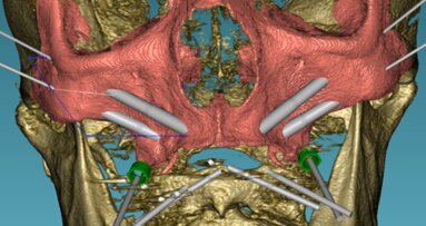 Rehabilitatie van edentaten: implantaten met remote verankering bij patiënten met zeer ernstige atrofische maxilla