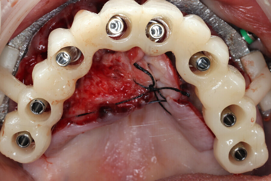 Fig. 5c: Provisional PMMA restoration with holes to pick up the titanium cylinders.