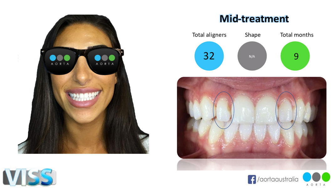 Fig. 43: Patient’s facial photograph and close-up view of the patient’s smile after clear aligner treatment had commenced, but prior to soft-tissue recontouring and veneers.