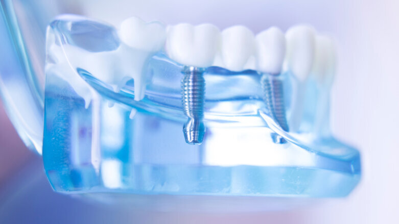 Novel technology could improve efficacy of metal-based dental implants