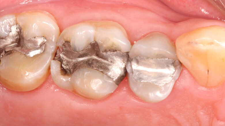US dentists are using nearly half of country’s total mercury in products
