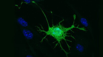 Célula-tronco da polpa dentária transformada em célula cerebral