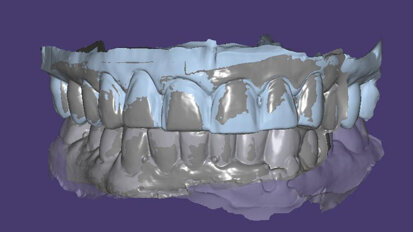 Digital face-bow transfer technique dentofacial analyser for dental aesthetics