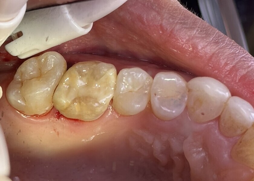 Fig. 17: After luting of the inlay to the prepared tooth and finishing of the margins.