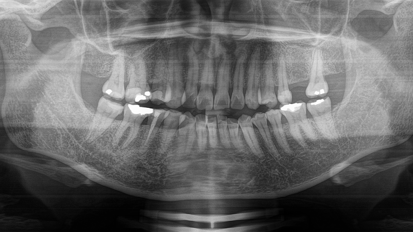 Utilising R-SWEEPS laser-assisted irrigation for the treatment of chronic periapical periodontitis