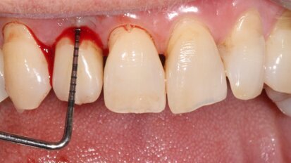Valutazione dell’efficacia dello spazzolino elettrico Oral-B iO nei pazienti con riabilitazioni implantari fisse