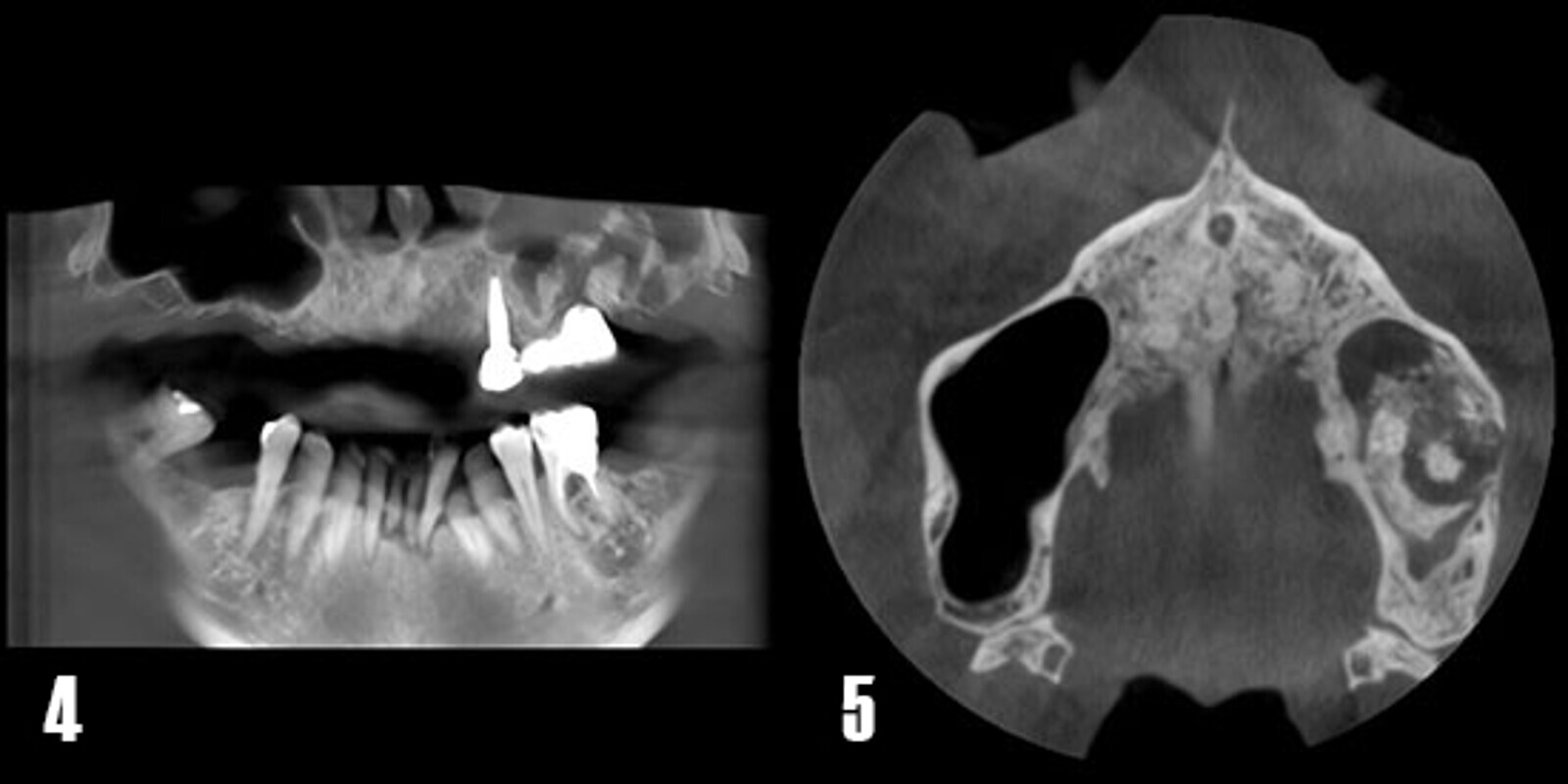 Fig. 4. Corte panorÃ¡mico de TCHC. Se observa ocupaciÃ³n del seno maxilar izquierdo junto con fragmentos del biomaterial utilizado en una elevaciÃ³n de seno previa. El paciente fue rehabilitado con un puente de tres piezas tras lo que el implante 26 fracasÃ³ y produjo una comunicaciÃ³n orosinusal y sinusitis. Fig. 5. Corte axial donde se observa el seno maxilar izquierdo completamente ocupado y con material de injerto radiopaco disperso. 