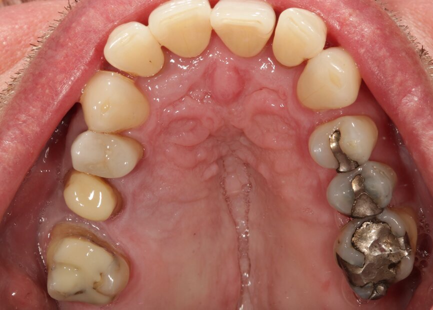 Fig. 2a: The patient desired replacement of the large-surface amalgam fillings in the upper (a) and lower jaw (b) with full-ceramic restorations.