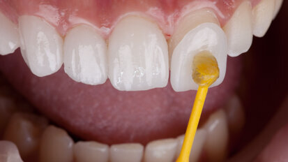 Các nhà nghiên cứu đề xuất veneers in 3D của họ là tương lai