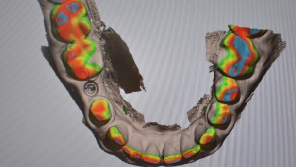 Skanowanie z poziomu implantu – część 1