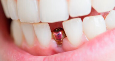 Una Consensus Conference europea di aggiornamento sugli impianti dentali