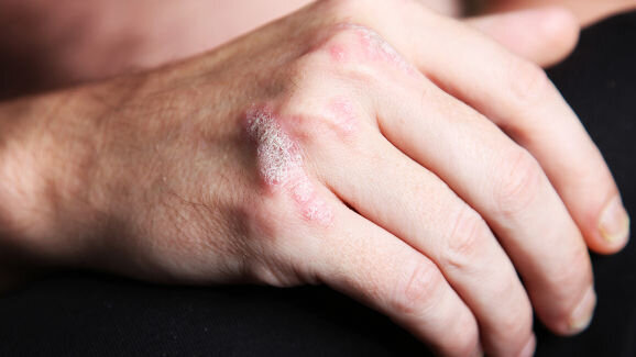 Smoking as a permissive factor of periodontal disease in psoriasis