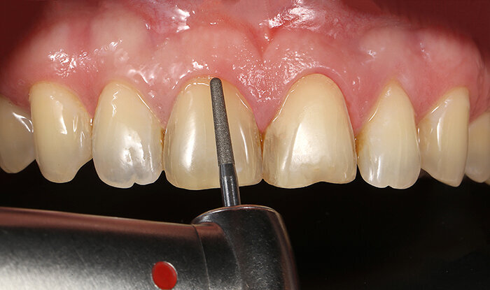 Fig. 5: The minimally invasive preparation during the application of a micro chamfer in the cervical area.