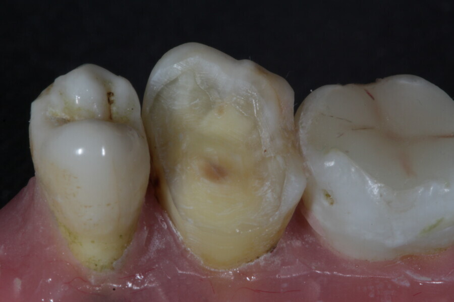 Fig. 36: Large tooth lesion with missing walls.