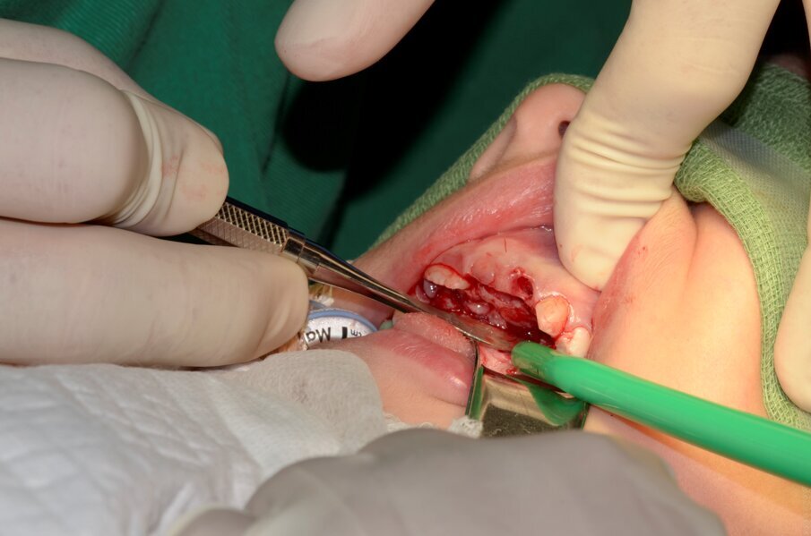 Fig. 5. Palatal intracrevicular incision