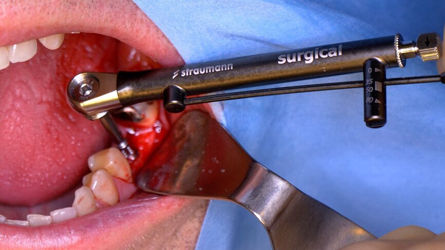 Fig. 5: Surgical torque control instrument showing the implant in the final position and a torque value of 35 N cm.