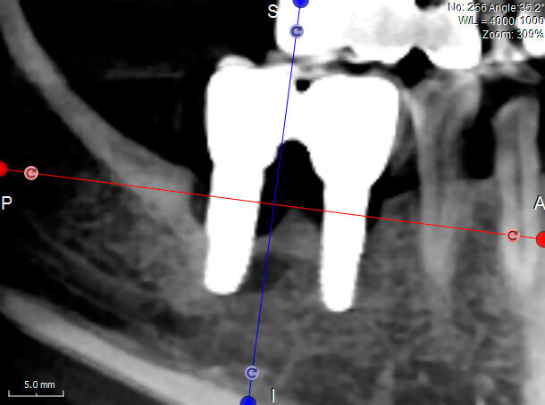 Fig. 1 - CBCT in sezione laterale. I coni di riassorbimento coinvolgono un’ampia porzione della superficie implantare.