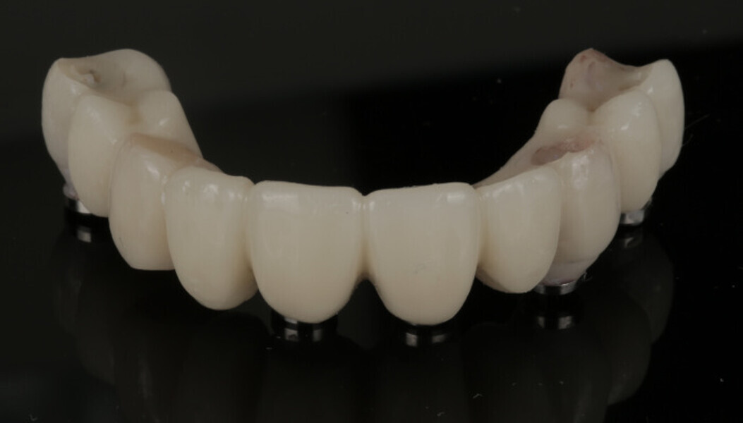 Fig. 15: Provisional prosthesis after removal of the anchor pins and palatal supports.