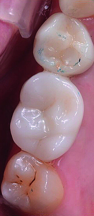 Fig. 15e