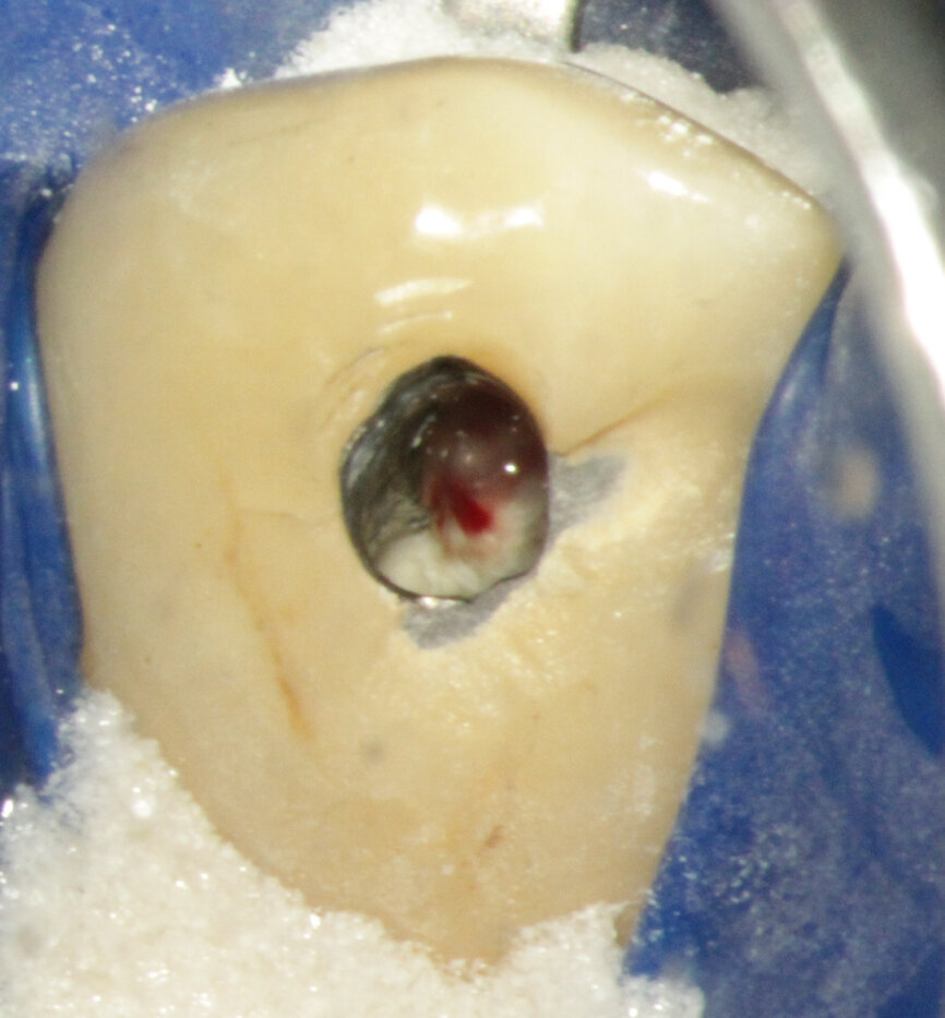Fig. 3b: (a) Radiolucency in the cervical part of the canine. (b) Bleeding from the perforation. (c) MTA application with the MAP System and PD MTA White. (d) Original canal and repair of root perforation. (e) Post-op radiograph showing the root canal filling.