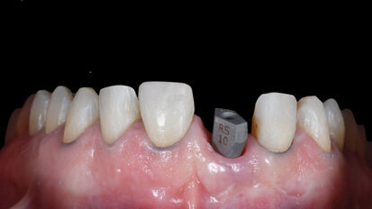 De Invisalign Smile Architect-software maakt het combineren van orthodontische en restauratieve behandelplannen mogelijk
