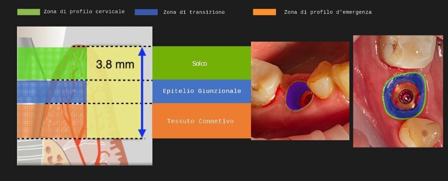 Fig. 24_La configurazione del complesso sopracrestale a 4 mesi per il caso 1.