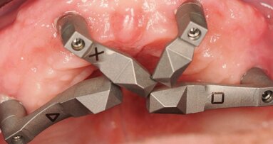 Quando il dato smette  di essere una promessa: ScanLogiQ, convergenza nella scansione implantare