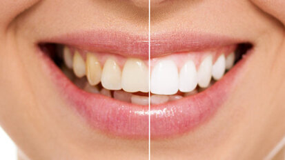 Man fined £11,500 for providing illegal tooth whitening and training