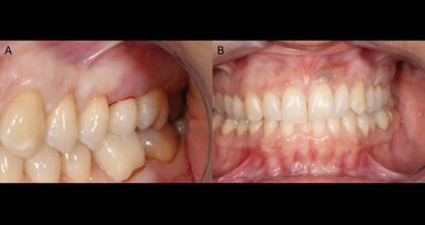Diagnosi precoce e gestione conservativa di una peri-implantite iniziale attraverso un approccio microbiome-based