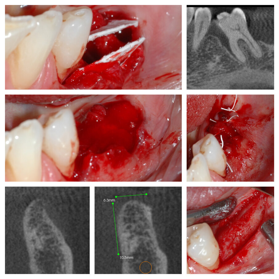 Fig. 4a_Elemento 36 mesio inclinato, deficit orizzontale in zona 35 risolto con tecnica S.A.T.