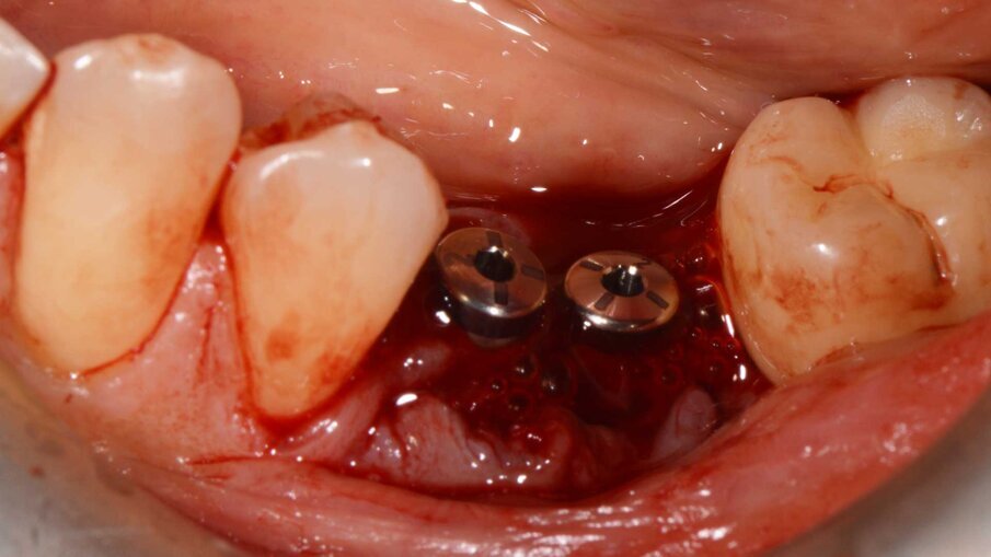 Fig. 6 - La matrice Geistlich Fibro-Gide è posizionata attorno ai collari implantari e imbevuta di gel REGENFAST.