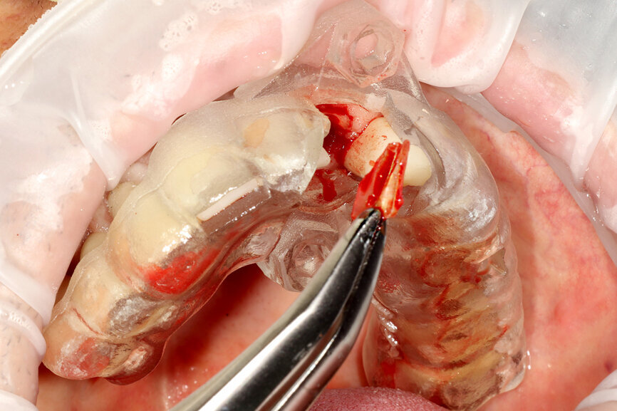 Fig. 20: The sectioned palatal root was carefully removed.