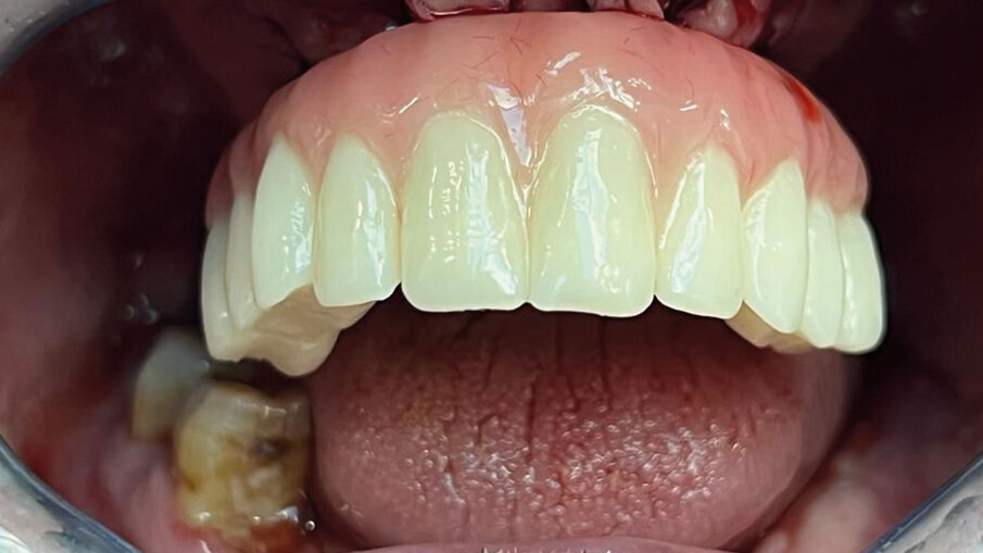 Fig. 15 - Inserimento dei denti provvisori subito dopo aver avvitato i monconi sul Device.