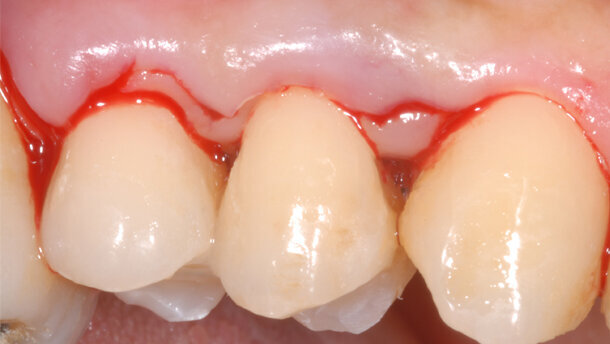 Single Flap Approach. Un approccio chirurgico semplificato ai difetti ossei parodontali