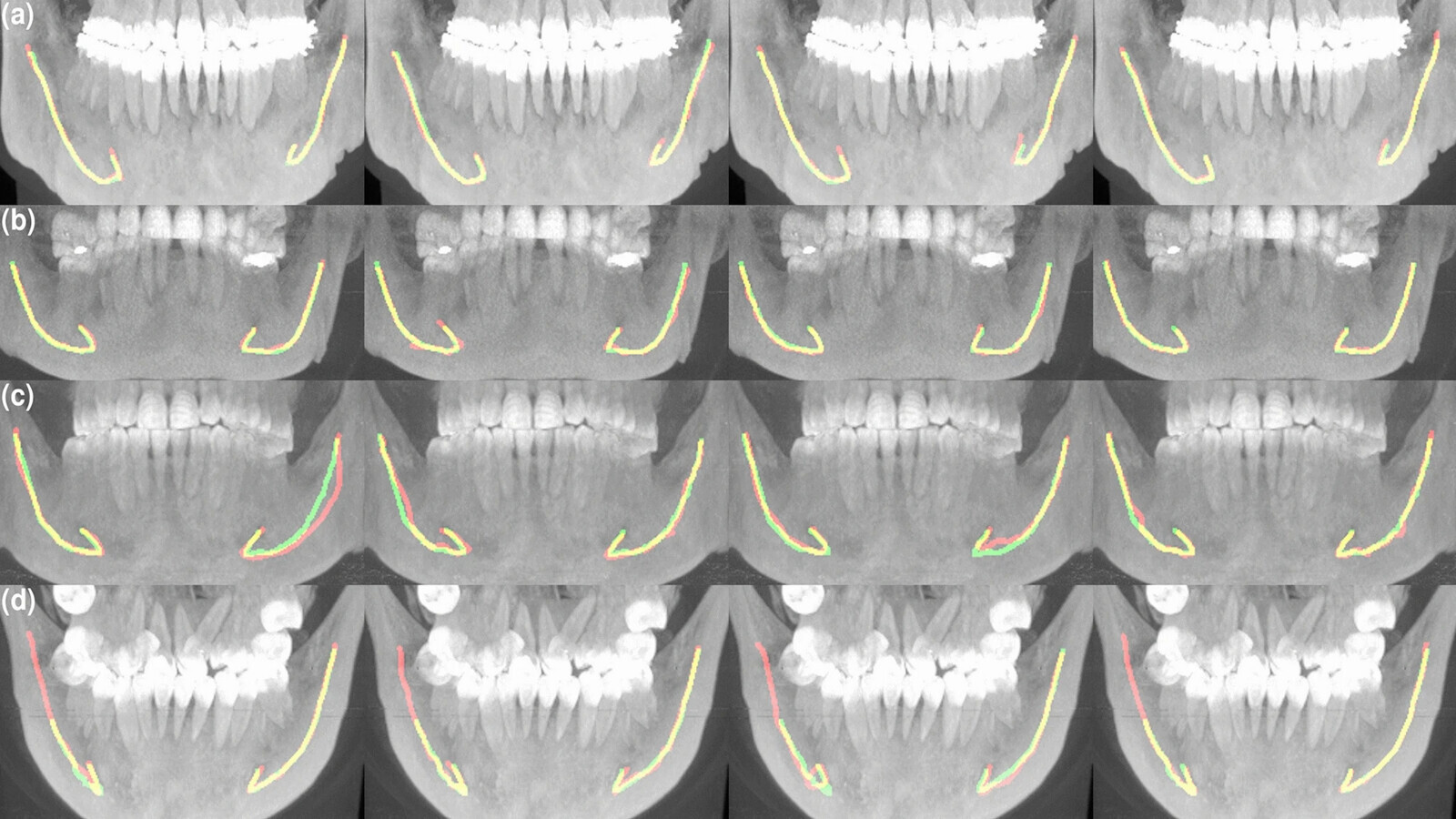 CBCT obrazovÃ¡ data zobrazujÃ­cÃ­ pÅekrÃ½vajÃ­cÃ­ se segmentace vytvoÅenÃ© specialisty na radiologii a umÄlou inteligencÃ­. ZakreslenÃ­ kanÃ¡lÅ¯ specialistou je na kaÅ¾dÃ©m obrazu oznaÄeno ÄervenÄ, znaÄenÃ­ vÃ½sledkÅ¯ umÄlÃ© inteligence je znÃ¡zornÄno zelenÄ a pÅekrytÃ­ shodujÃ­cÃ­ se identifikace kanÃ¡lÅ¯ specialistou a umÄlou inteligencÃ­ je znaÄeno Å¾lutÄ. (ObrÃ¡zek: Â© 2022 JÃ¤rnstedt a kol., licencovÃ¡no pod CC BY 4.0.)