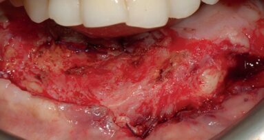 Periimplant soft-tissue management in patients with a fibula free flap reconstruction: Case series and description of a new technique
