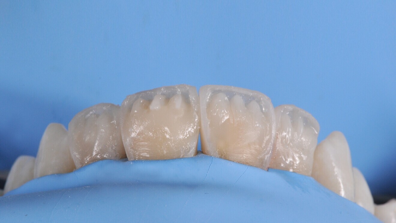 Distinct mamelons created by hand to restore the smile of a young patient.