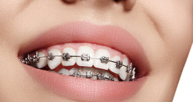 New adhesive prevents dental caries around orthodontic brackets