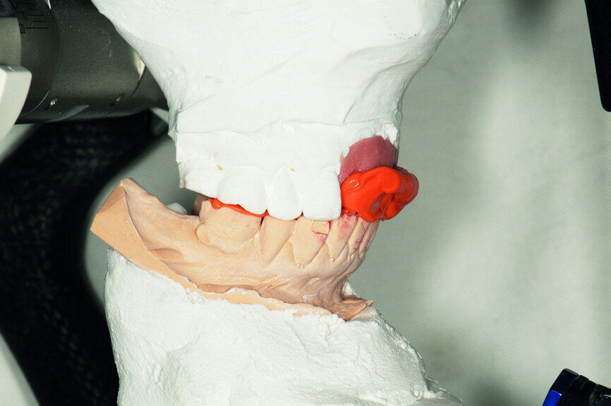 Fig. 33: Cross-mounting of the maxillary cast model.